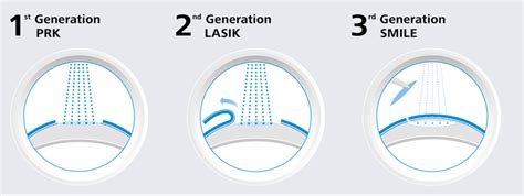 Relex Smile Lasik Sight Center