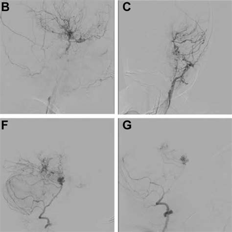 This Is A Digital Subtraction Angiography Dsa Lateral Projection