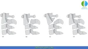 Hangman's Fracture | OrthoFixar 2025