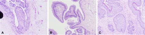 A Scalp Biopsy Specimen Showing Acanthosis Papillomatosis Increased