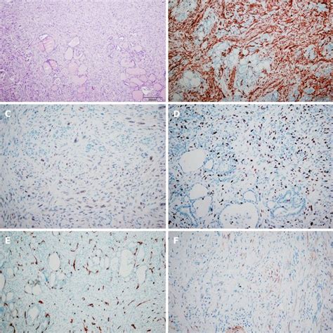 The Tumor Cells Tested Positive For Alpha Smooth Muscle Actin Download Scientific Diagram