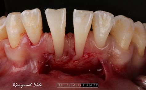 free gingival graft