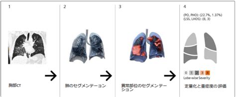 メディカルwatch Blog Archive シーメンスヘルスケア、新型コロナウイルス感染症の解析をサポートする臨床研究用ソフ ト