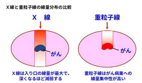 重粒子線治療とは Qst病院（旧放射線医学総合研究所病院）｜重粒子線治療（がん治療）