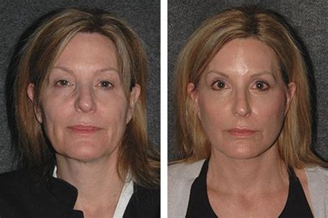 New York Facelift Specialist Dr Andrew Jacono Facelift Before And