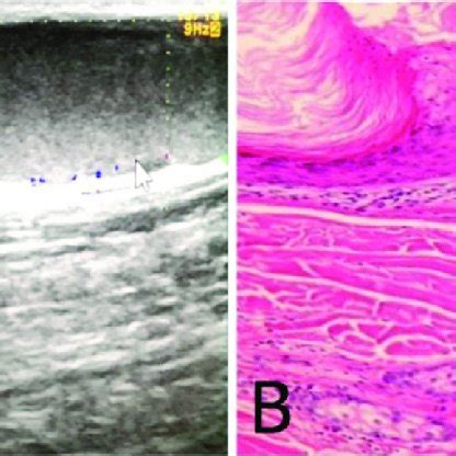 Intra operative images of step-by-step of resection of an epidermoid ...