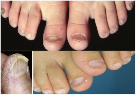 Nail Signs Koilonychia Spoon Nails 反甲 Tangs Clinical Tcm