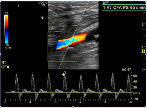 Approach To The Patient With Peripheral Arterial Disease Circulation