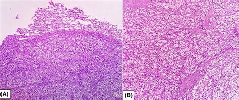 A Magnification Photomicrograph Showing Clear Cell Renal Cell