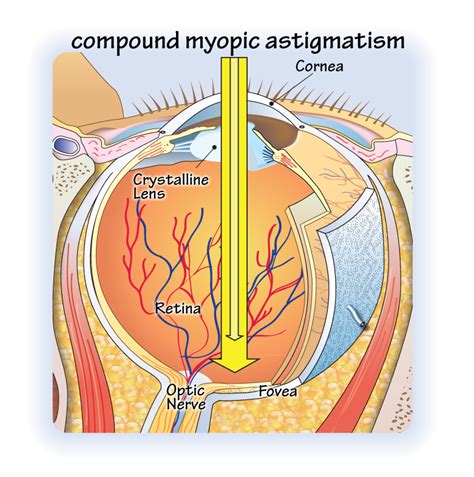 compound-myopic-astigmatism | OpticianWorks Online Optician Training