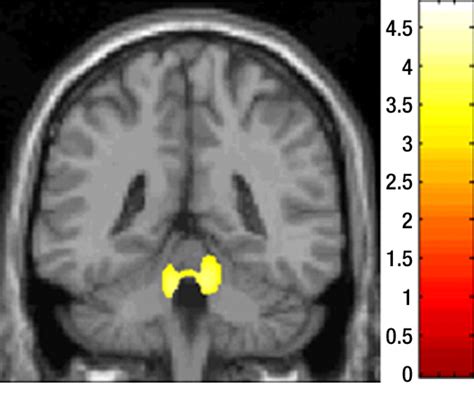 Mr Imaging Of Multiple Sclerosis Radiology