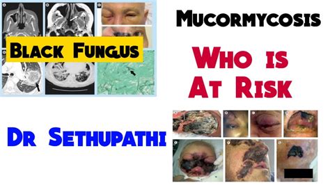 Mucormycosis Black Fungus Clinical Features Diagnosis Treatment