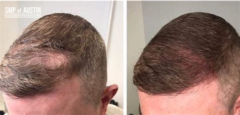 Scalp Micropigmentation Smp Of Austin