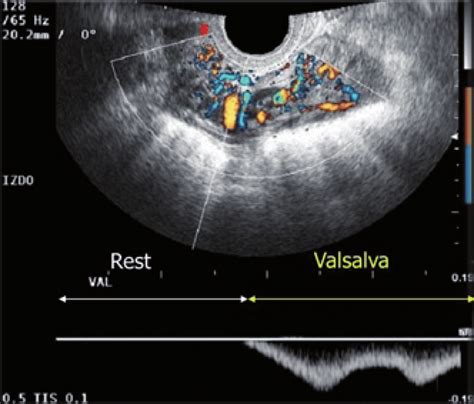 3 Transvaginal Color Doppler Ultrasonography In A Patient With