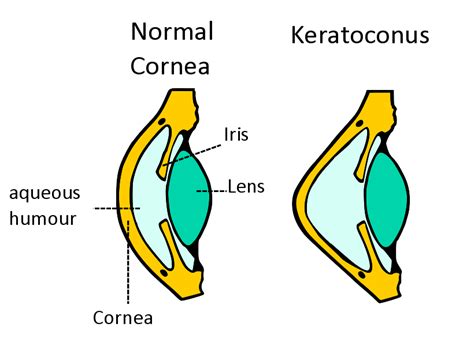 Corneal Ectasia Causes Types Symptoms And Treatments