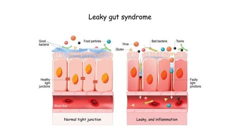 What Is A Leaky Gut Goolsby