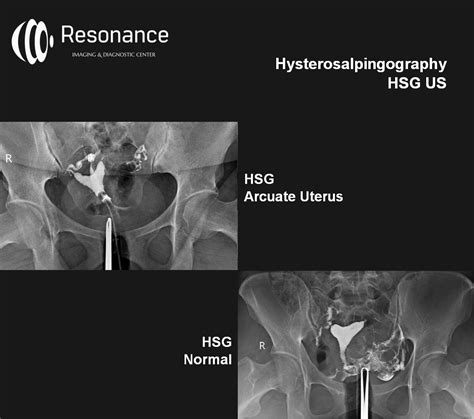 Uterine Septum Hsg