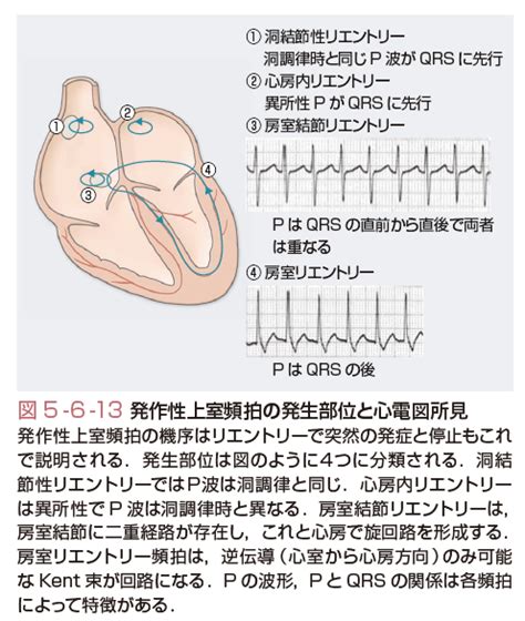 発作上室性頻拍とは？ 意味や使い方 コトバンク