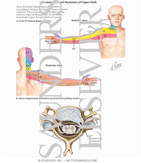 Cervical Radiculopathy