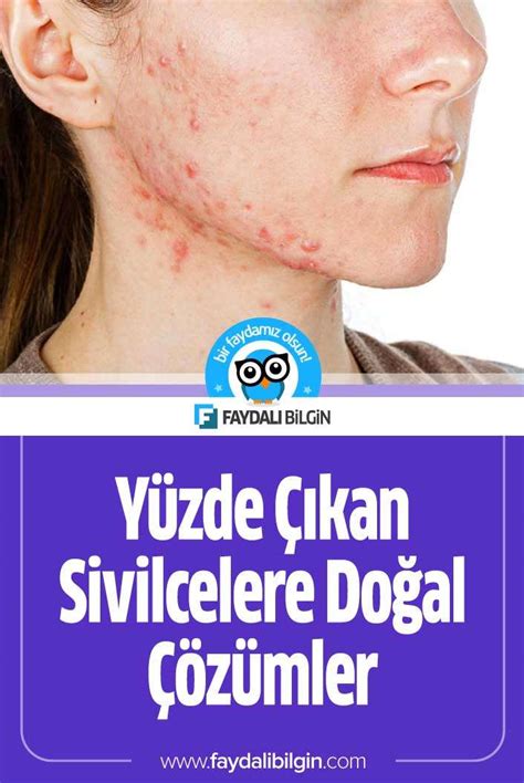 Y Zde Kan Sivilcelere Do Al Z Mler Y Zde Kan Sivilceler