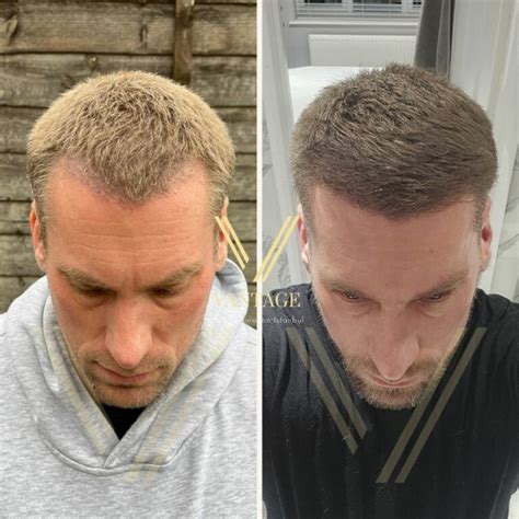 Hair Transplant For Receding Hairline Norwood Scale 2024 Costs