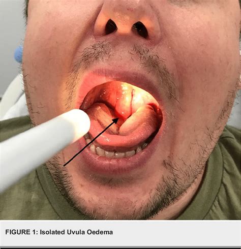 Figure 1 From A Case Of Recurrent Isolated Uvula Oedema Secondary To