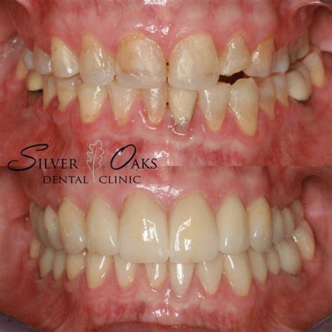 Straighten Teeth Without Braces Silver Oaks Dental Clinic