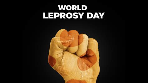 Leprosy In United States 2024 - Dulcia Nonnah