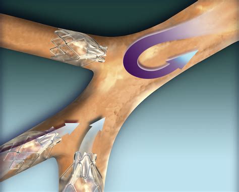 Endobronchial Devices Questions And Answers In MRI