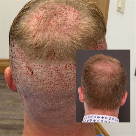 What Is A Neograft Hair Transplant Benefits Procedure Results