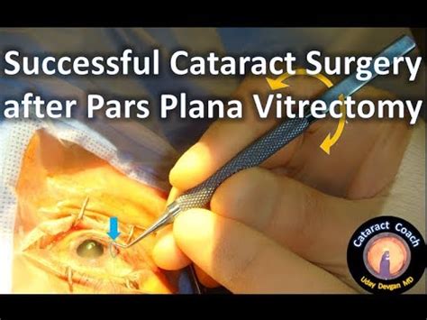 Cataract Surgery After Prior Pars Plana Vtirectomy Youtube