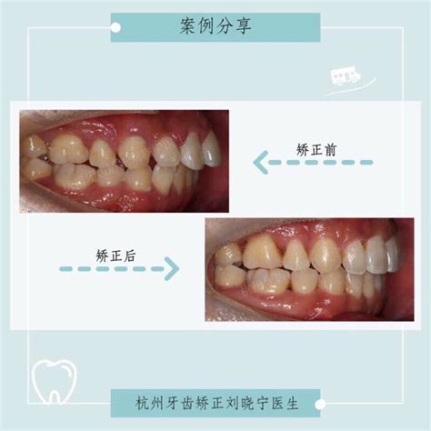 杭州牙齿矫正刘晓宁正畸案例集：正畸代偿治疗改善骨性偏斜的隐适美案例解析 哔哩哔哩