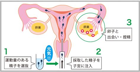 不妊治療って何をするの？不妊治療の原因・種類・方法・費用について徹底解説！ ママレポ