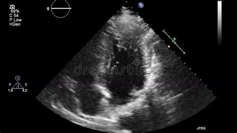 This Is Known As Aortic Insufficiency Or Aortic Regurgitation Stock Illustration Illustration