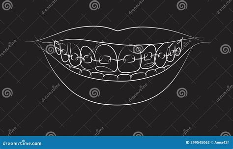 Teeth Braces Types Realistic Infographics Vector Illustration