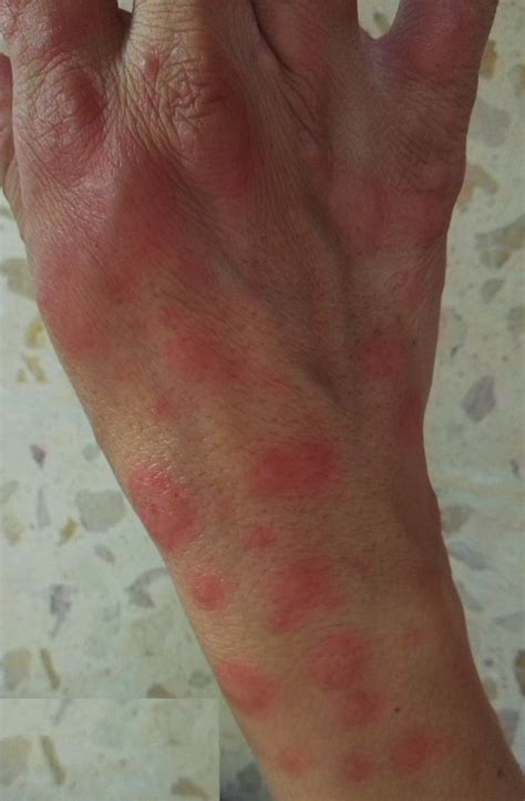 Raised Erythematous Pruritic Skin Eruption Involving The Dorsal Aspect