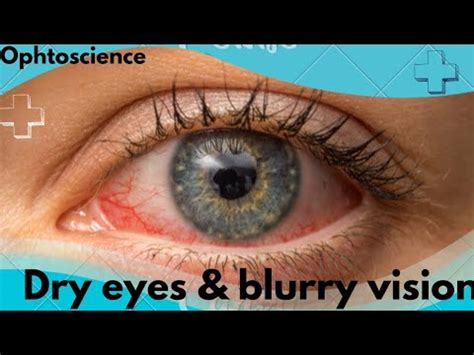 Why dry eye cause blurry vision? | Treatment with home remedies | Dry ...