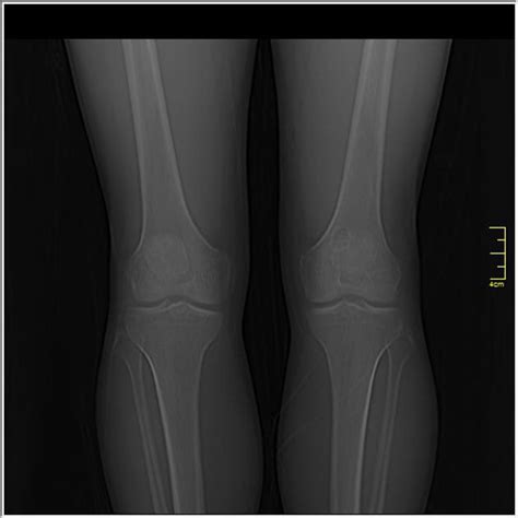 Simple Bone Cyst Radiology Case