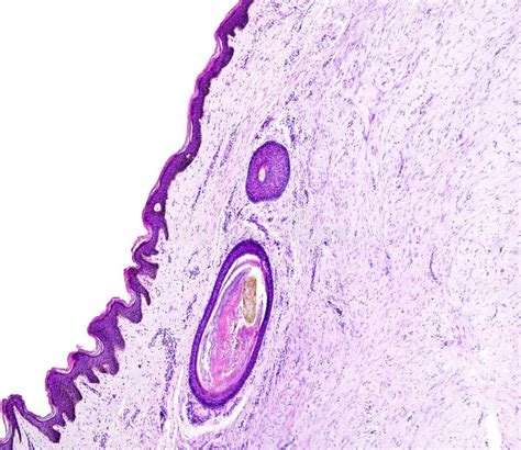 La Histología Del Tejido Humano Muestra La Metaplasia Squamous De La