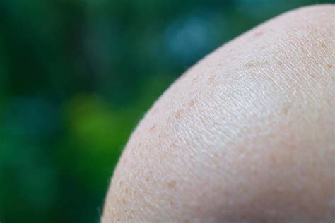 Tumori Della Pelle Cos è Il Melanoma Sintomi Prevenzione E Cura