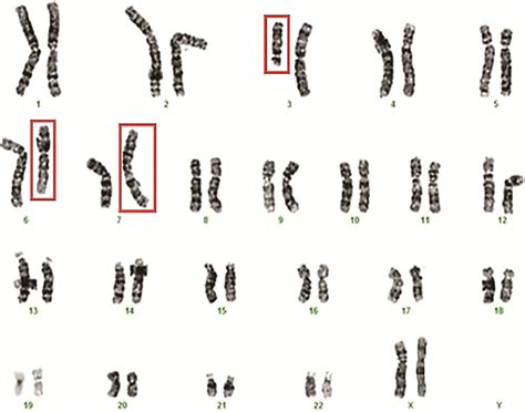 Sickle Cell Anemia Karyotype