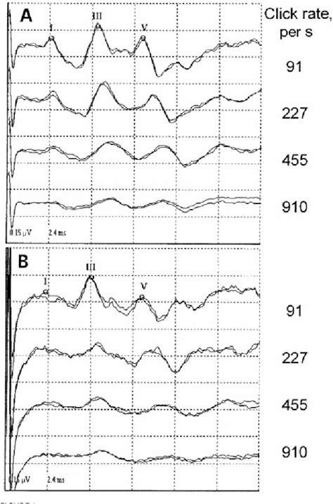 Figure 1 From Functional Impairment Of The Brainstem In Infants With Bronchopulmonary Dysplasia