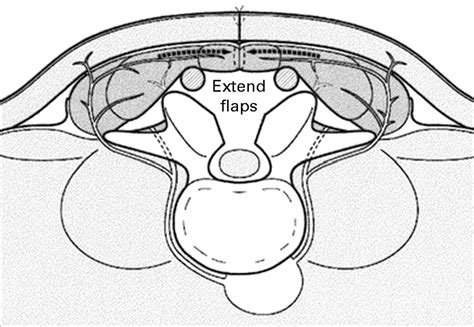 The Management Of Complex Soft Tissue Defects After Spinal