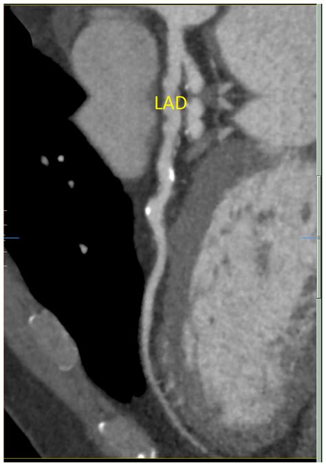 Diseases Free Full Text St Elevation Myocardial Infarction In