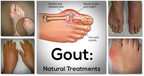 Say Goodbye To Gout Forever With This Powerful Natural Treatment