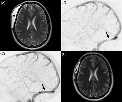 Reversal Of Intracranial HypertensionRelated Pseudomeningocele After