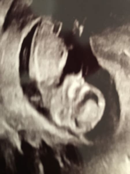 Week Scan Gender Guess Mumsnet