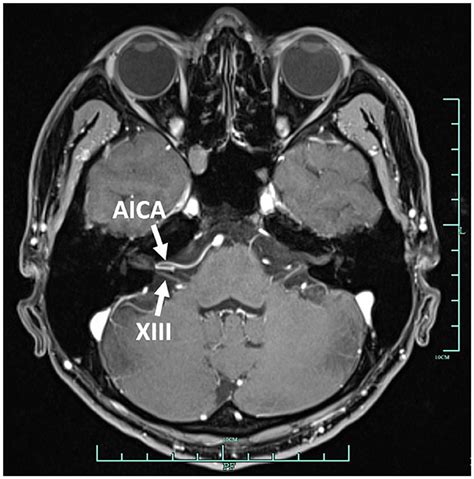 Vestibular Nerve Mri