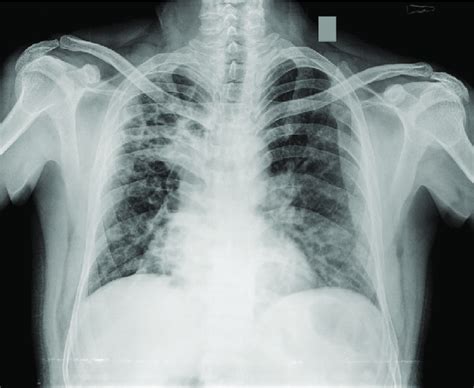 Chest Radiograph Postero Anterior View Showing Cystic Bronchiectasis