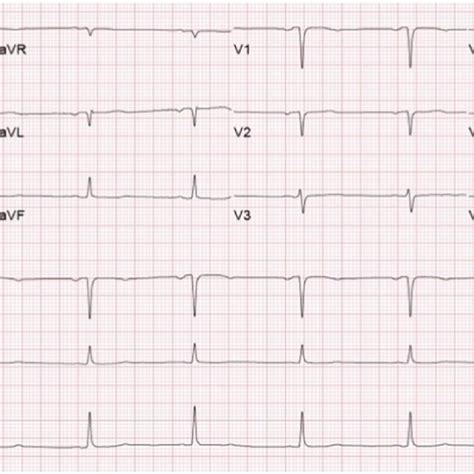 Electrocardiography Showing Sinus Tachycardia With Mm St Segment